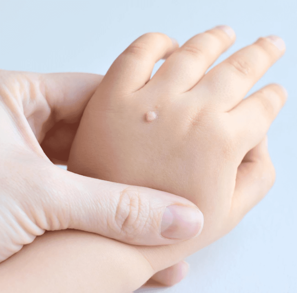 Pedskin Research pediatric dermatology