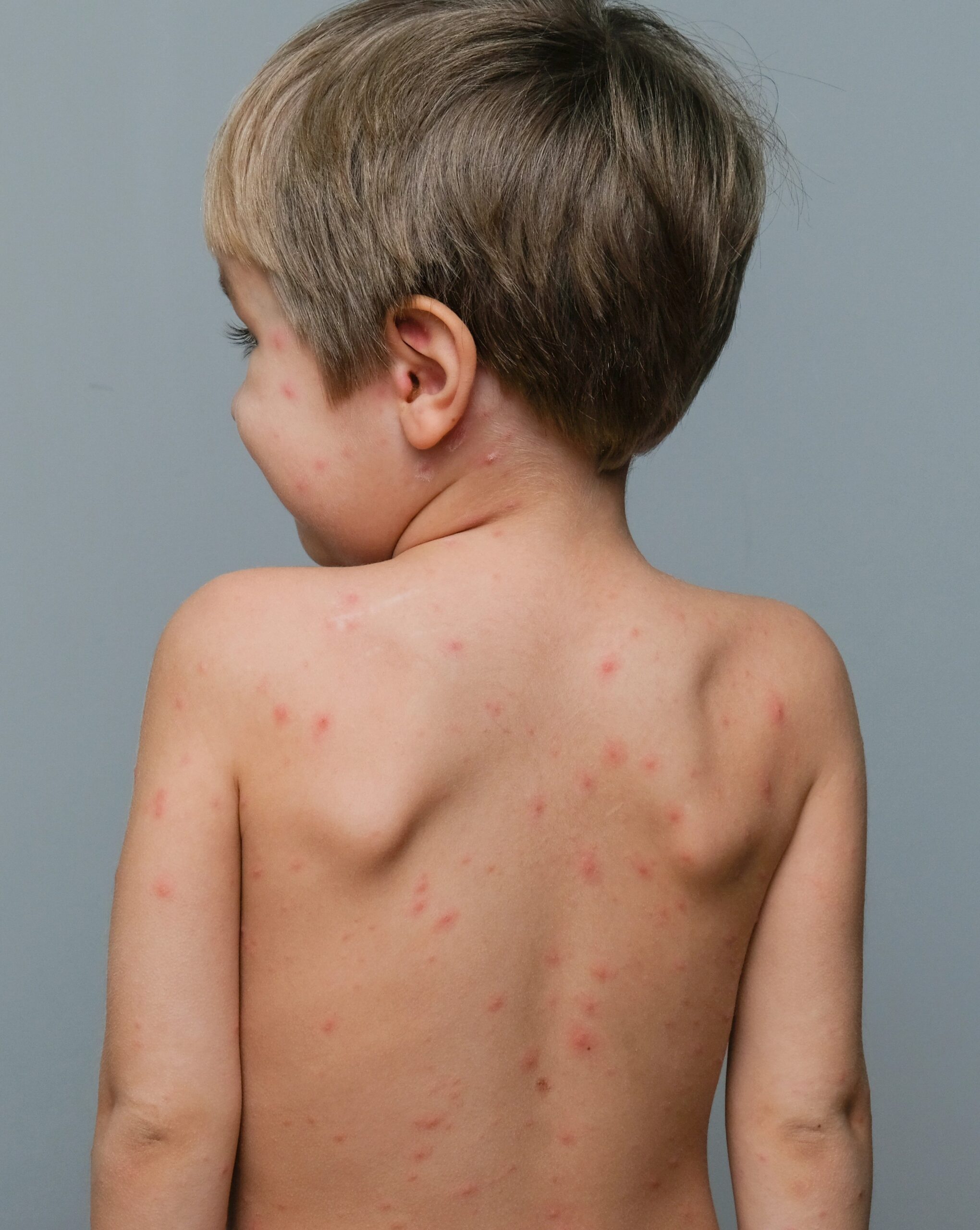 Pedskin Research – pediatric dermatology Pedskin Research children’s skin health