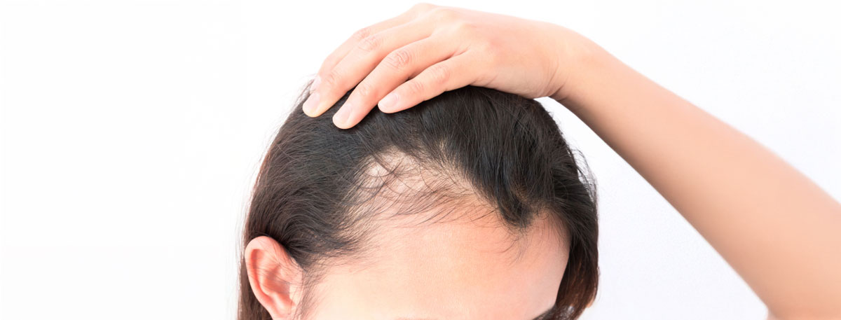 Scalp hair loss in a child being examined for alopecia, highlighting expert diagnosis and treatment by a pediatric alopecia specialist in Miami.