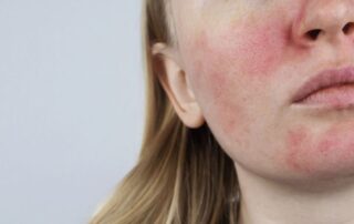 Child with visible atopic dermatitis symptoms on the face, showing redness and irritation commonly associated with pediatric eczema in Miami’s climate.