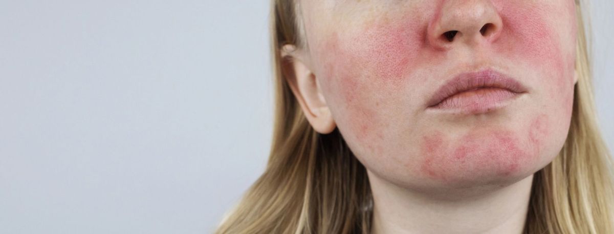 Pedskin Research – pediatric skin diseases Child with visible atopic dermatitis symptoms on the face, showing redness and irritation commonly associated with pediatric eczema in Miami’s climate.