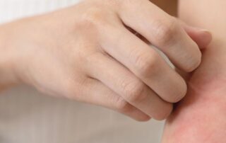 Red, inflamed eczema flare-up on a child’s arm caused by atopic dermatitis, showing common symptoms parents should recognize.