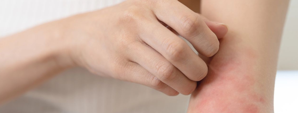 Red, inflamed eczema flare-up on a child’s arm caused by atopic dermatitis, showing common symptoms parents should recognize.